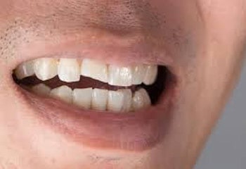 broken teeth