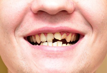 Broken Teeth Treatment in Dublin  Portobello Dental Clinic