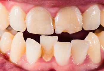 broken teeth