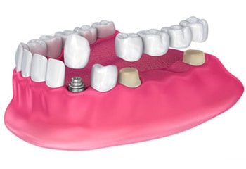 supported denture