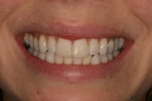 after dental bonding