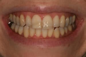 before dental bonding