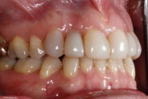 pre veneers